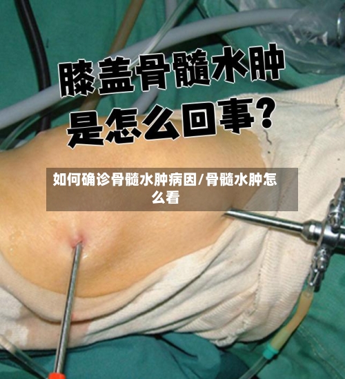 如何确诊骨髓水肿病因/骨髓水肿怎么看