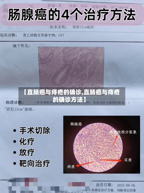 【直肠癌与痔疮的确诊,直肠癌与痔疮的确诊方法】