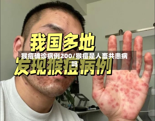 猴痘确诊病例200/猴痘是人畜共患病吗-第2张图片