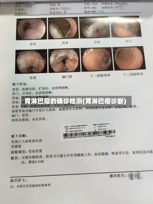 胃淋巴瘤的确诊检测(胃淋巴瘤诊断)