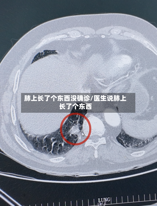 肺上长了个东西没确诊/医生说肺上长了个东西