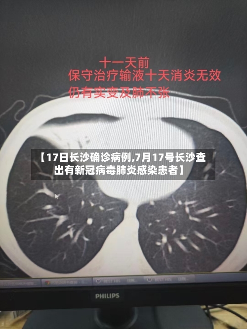 【17日长沙确诊病例,7月17号长沙查出有新冠病毒肺炎感染患者】