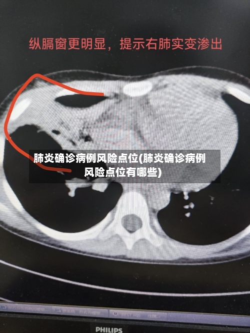肺炎确诊病例风险点位(肺炎确诊病例风险点位有哪些)-第2张图片