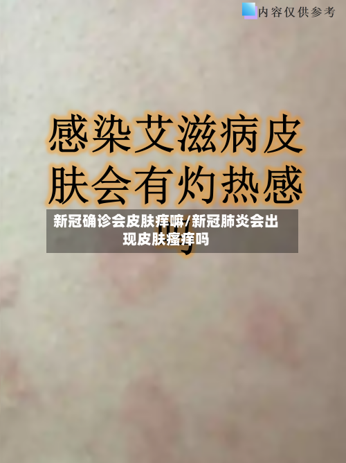 新冠确诊会皮肤痒嘛/新冠肺炎会出现皮肤瘙痒吗-第2张图片