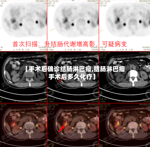 【手术后确诊结肠淋巴瘤,结肠淋巴瘤手术后多久化疗】-第2张图片
