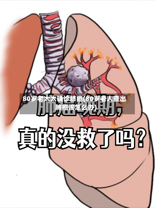 80岁老太太确诊肺癌(80岁老人查出肺癌该怎么办)-第3张图片