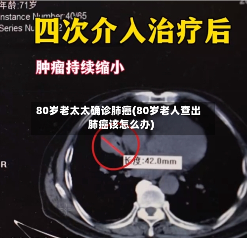 80岁老太太确诊肺癌(80岁老人查出肺癌该怎么办)